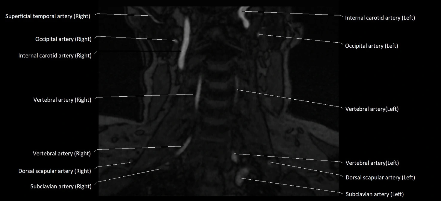 MRA carotid artery anatomy cross sectional 3T coronal image 9.webp